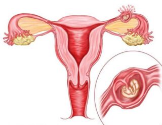 Внематочная беременность. Что это такое?