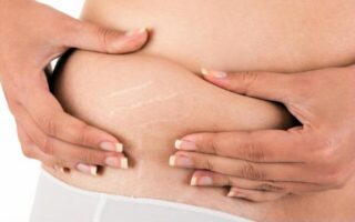 Растяжки при беременности