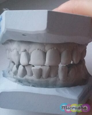 Брекеты — ставить или нет. Личный опыт, фото.