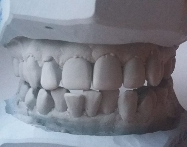 Брекеты — ставить или нет. Личный опыт, фото.