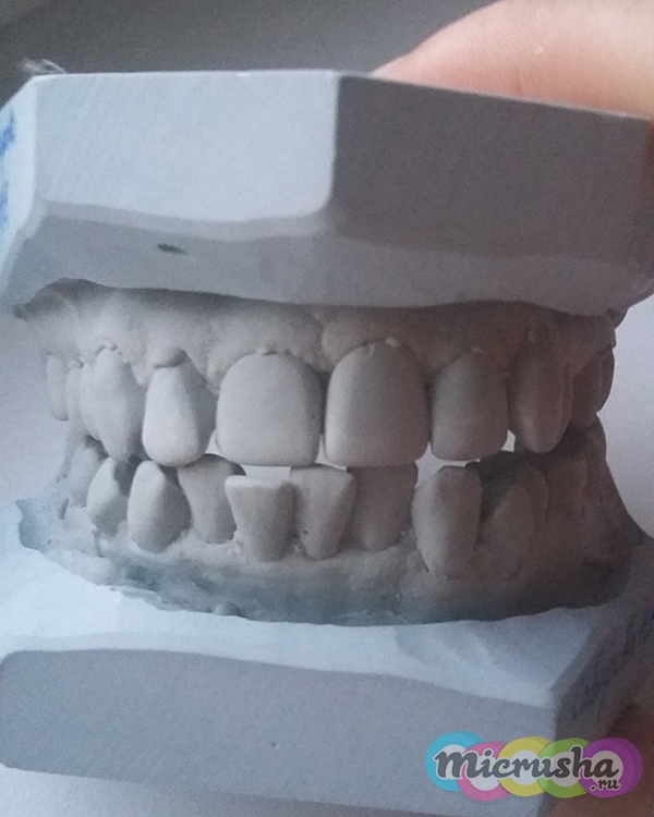 Брекеты — ставить или нет. Личный опыт, фото.