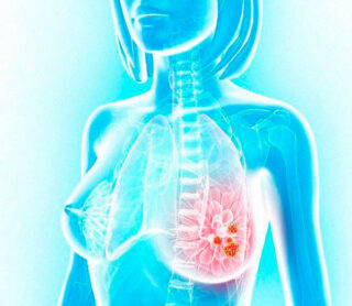 Маммолог. Самообследование. Когда нужно обратиться к врачу?