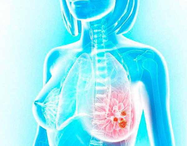 Маммолог. Самообследование. Когда нужно обратиться к врачу?