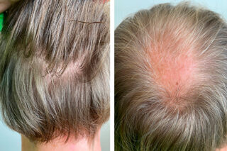 Пересадка волос для мужчин. Стоимость операции и как она проходит.