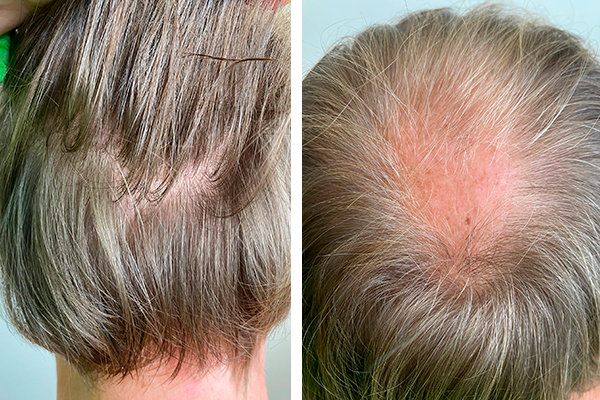 Пересадка волос для мужчин. Стоимость операции и как она проходит.