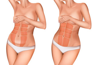 Упражнения для женщин с диастазом